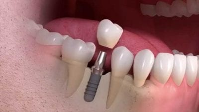 Advanced Dental Implants