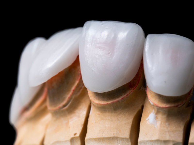 Custom Dental Veneers