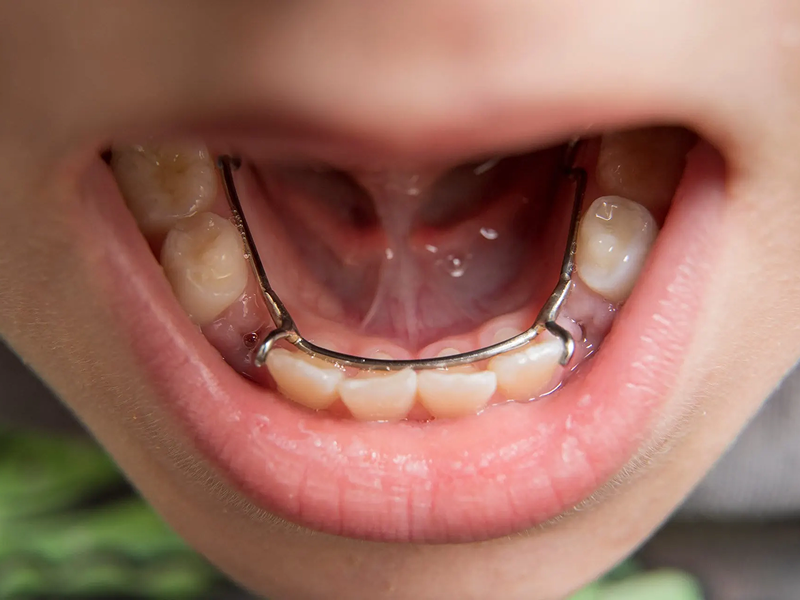 Interceptive Orthodontics