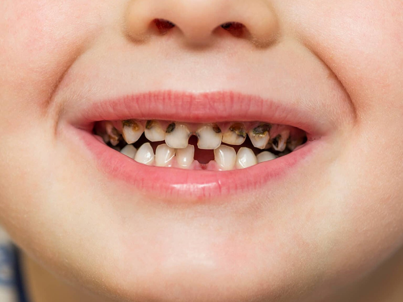 Nursing Bottle Caries Treatment